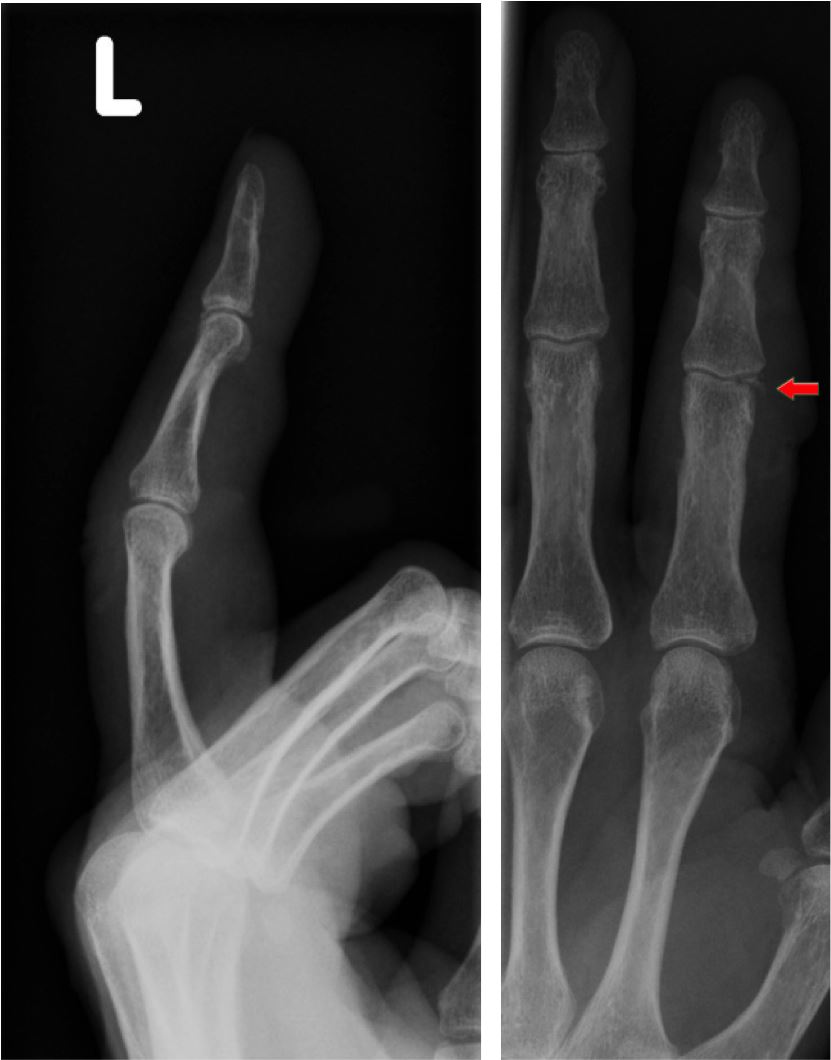 compression-fracture-treatment-finger-bosdeck